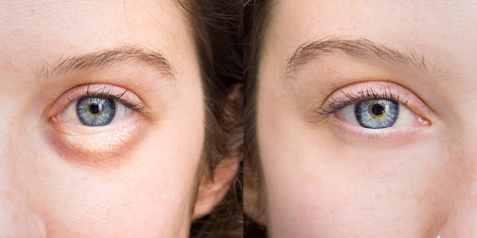 7 Reasons You Have Puffy Eyes and How to Fix Them