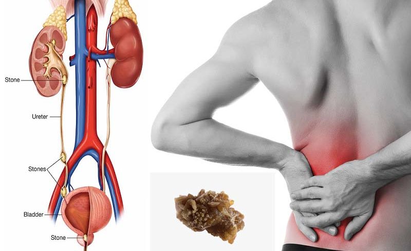 Kidney Stone Symptoms and Risk Factors
