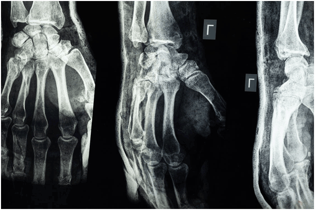 Hand Injury x-ray